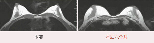 杭州艺星自体脂肪隆胸效果