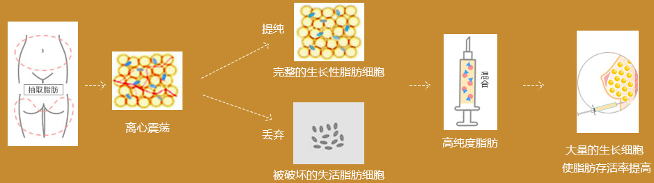 杭州艺星自体脂肪隆胸效果