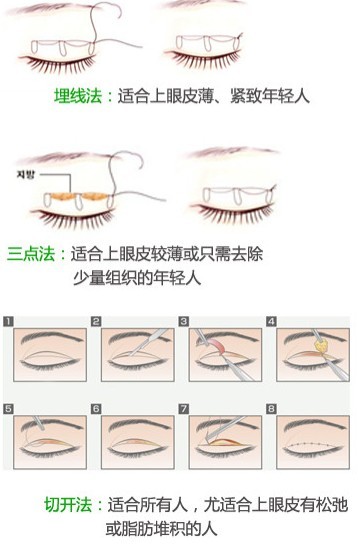 你适合做双眼皮吗?